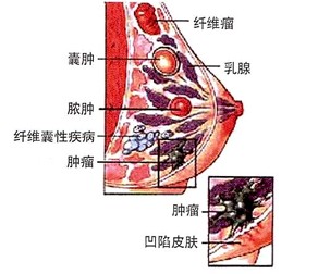 主页 乳腺疾病 乳腺囊肿 乳房肿瘤是是乳腺癌前期最常见的病症